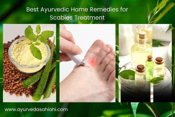 5 Home Remedies For Scabies Treatment